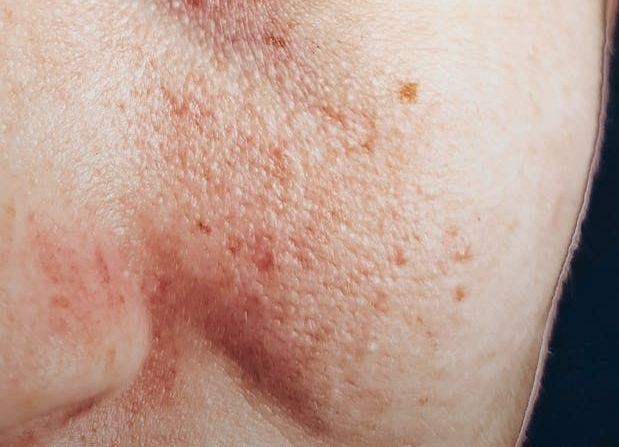 ¿Qué calma una piel sensible?